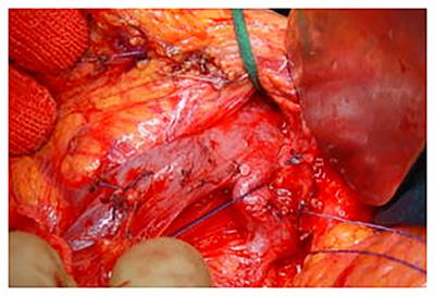 Results of Standard Stapler Closure of Pancreatic Remnant After Distal Spleno-Pancreatectomy for Adenocarcinoma